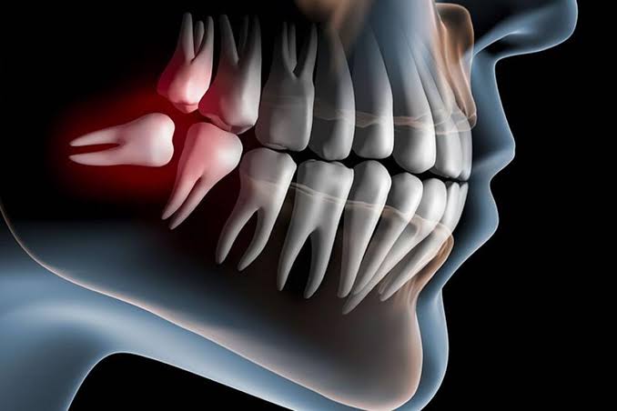 Cirurgia de dentes inclusos (Siso)