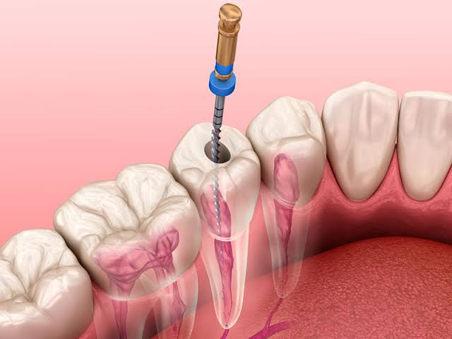 Tratamento de Canal (Endodontia)