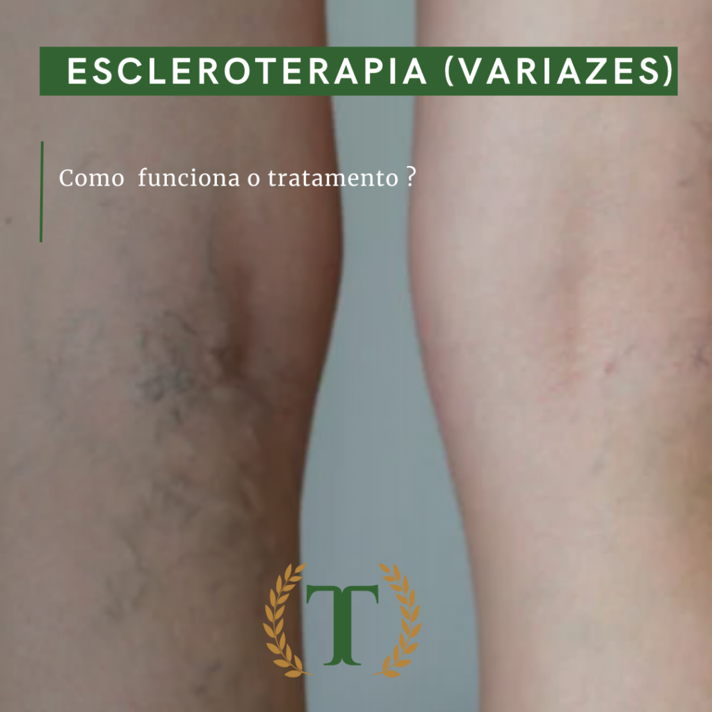 Escleroterapia (varizes) - Thalles Diniz Odontologia Estética E Saúde